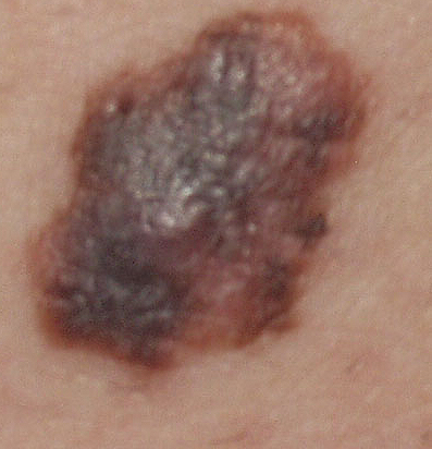 Melanoma a diffusione superficiale